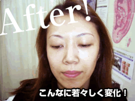 美容鍼施術後(6回施術) After 美容鍼施術後(6回施術) After